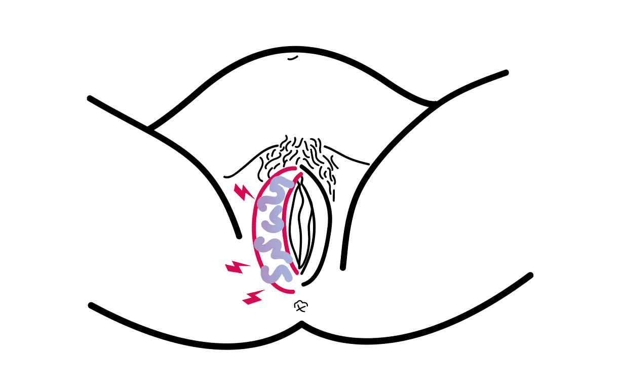 Schéma d’une vulve présentant une varice vulvaire sous forme de veines apparentes bleues et enflées sur l’une des deux lèvres externes.