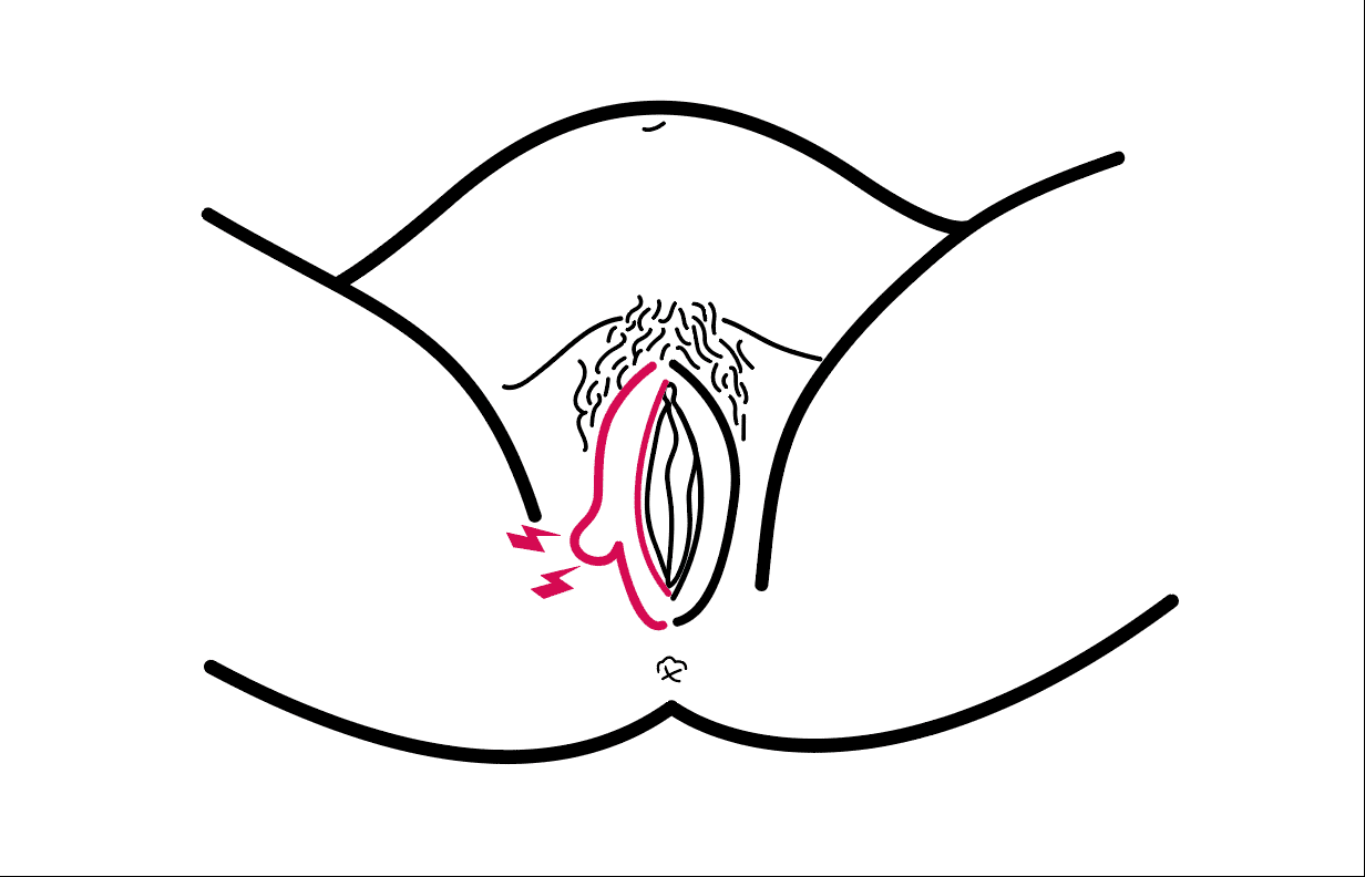 Schéma d’une vulve présentant une varice vulvaire sous la forme d’une boule sur l’une des deux lèvres externes.